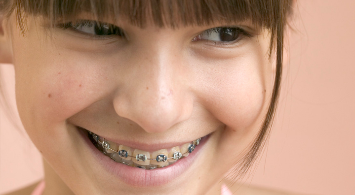 Çocuğa Diş Teli Taktırmak Şart Mı?
