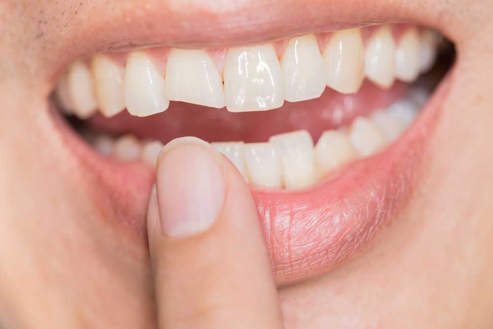 Travma Görmüş Dişlerin Ortodontik Tedavisi
