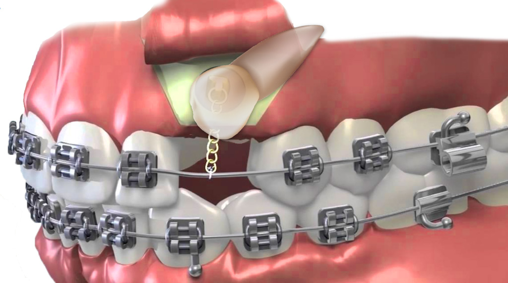 Gömülü Dişlerin Ortodontik Tedavisi