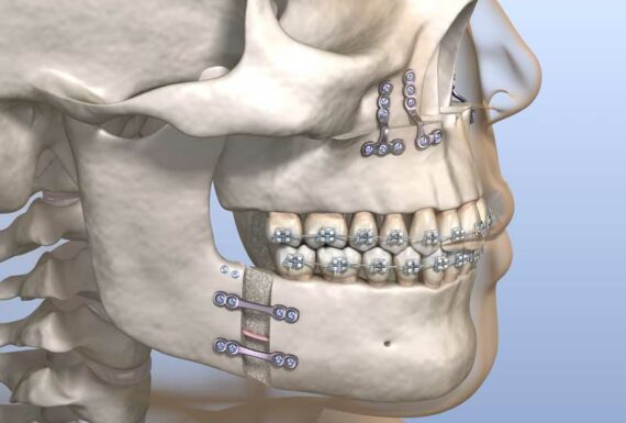 Ortognatik Cerrahi